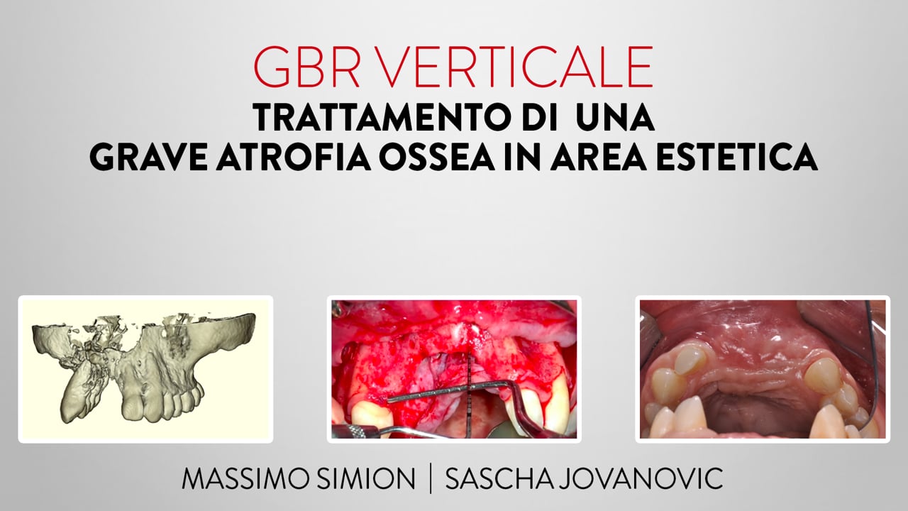 Teaser Live Surgery Simion-Jovanovic